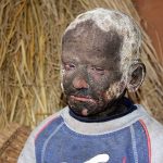 پسری که کمکم تبدیل به سنگ میشود +تصاویر