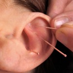 طب سوزنی در گوش یا آریکولوتراپی