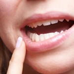 کمبود این ویتامین ها منجر به آفت دهان می شود