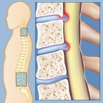 تنگی کانال نخاعی, علل و علائم آن