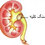 بهترین خوراکی برای دفع سنگ کلیه