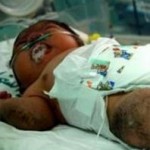 یک نوزاد در غزه شبیه گوریل به دنیا امد+عکس