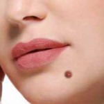 خال های صورت را با جراحی محو کنیم یا نکنیم؟