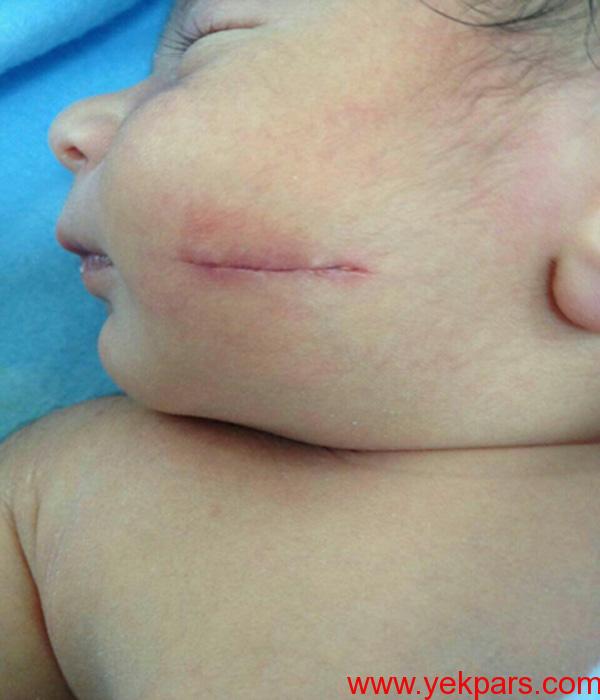 واکنش وزارت بهداشت یه جراحت صورت نوزاد +عکس واکنش وزارت بهداشت یه جراحت صورت نوزاد +عکس