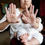 تولد پسری با ۳۱ انگشت +عكس