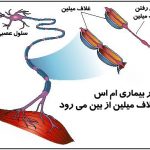 بیماری ام اس درمان شد