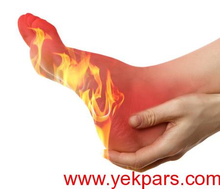 راه های پیشگیری و درمان داغی کف پا راه های پیشگیری و درمان داغی کف پا