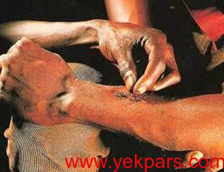 مورچه های عجیبی که بخیه جراحی میزنند +عکس