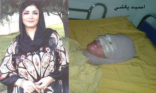 Image result for عکس اسید پاشی