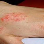 عوارض جدی اگزما که بیش از مشکلات پوستی است!