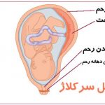 سرکلاژ چیست؟