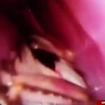 سوسک زنده در جمجمه زن هندی پیدا شد+عکس