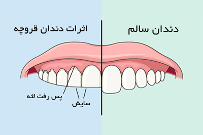 دندان قروچه در کودکان,دندان قروچه کودکان