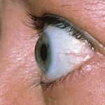 چرا چشمها از حدقه بیرون میزند؟