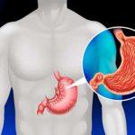 ۹ عادتی که باعث افزایش خطر سرطان معده می شود