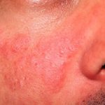 لوپوس چه نوع بیماری است؟+علائم