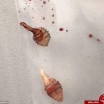 وارد شدن مگس زنده به زیر پوست دختر جوان+ تصاویر
