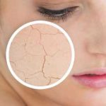 راه های مقابله با خشکی پوست