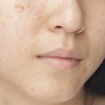 جای جوشها را به کمک این دارو محو کنید