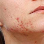  ۱۰ روش طبیعی درمان سریع جای جوش