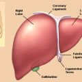 همه چیز درباره بیماری ویلسون