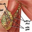 مرحله بندی پیشرفت سرطان سینه در زنان