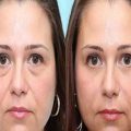 پف زیر چشم چیست و چگونه از شرش خلاص شویم؟