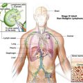 همه چیز درباره بیماری لنفوم