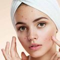 علت جوش زدن قبل از زمان پریود چیست؟