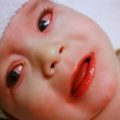 علل و علائم سندرم کاوازاکی