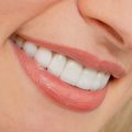 همه چیز درباره لمینت دندان
