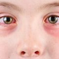چشمان صورتی یا التهاب ملتحمه چیست؟