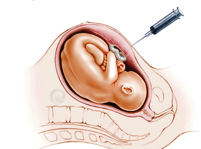 همه چیز درباره آمنیوسنتز