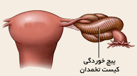 دلایل پیچ خوردگی و یا پیچیدن تخمدان