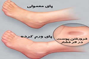 علت ورم پا و راههای سریع از بین بردن ورم