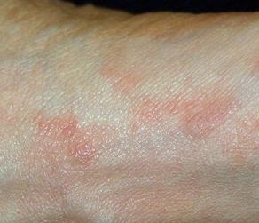 بیماری گال یا Scabies ناشی از چیست