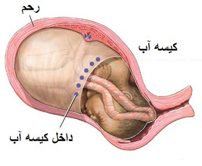 چرا اطراف جنین دچار کمبود آب می شود