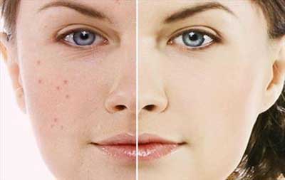 نکات آرایشی برای پوشاندن لک های روی پوست