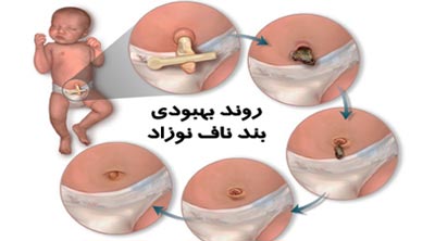 علل عفونت بند ناف نوزاد + درمان