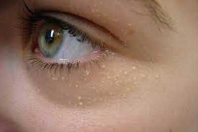 جوش های سفید دور چشم را چگونه درمان کنیم؟